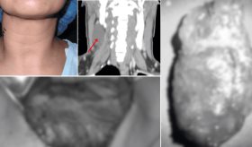 Presentación atípica de linfangioma en adulto: Tumoración cervical de 6cm sin disfagia ni disfonía