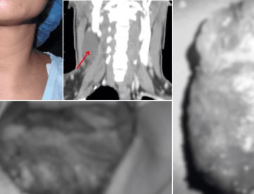 Presentación atípica de linfangioma en adulto: Tumoración cervical de 6cm sin disfagia ni disfonía