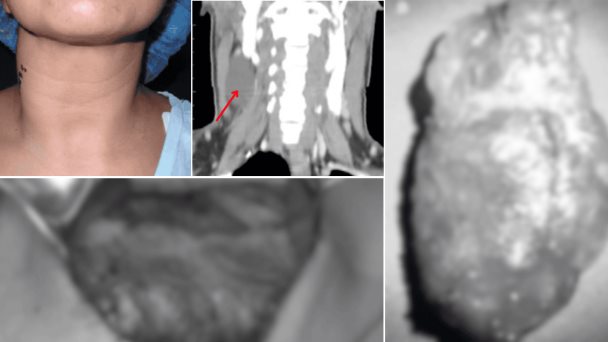 Presentación atípica de linfangioma en adulto: Tumoración cervical de 6cm sin disfagia ni disfonía Presentación atípica de linfangioma en adulto: Tumoración cervical de 6cm sin disfagia ni disfonía