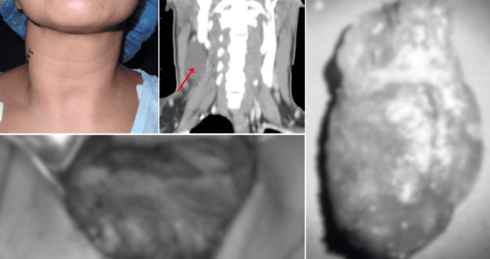 Presentación atípica de linfangioma en adulto: Tumoración cervical de 6cm sin disfagia ni disfonía