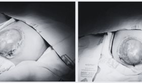 Neonato presenta gastrosquisis grave con evisceración intestinal y malformaciones asociadas