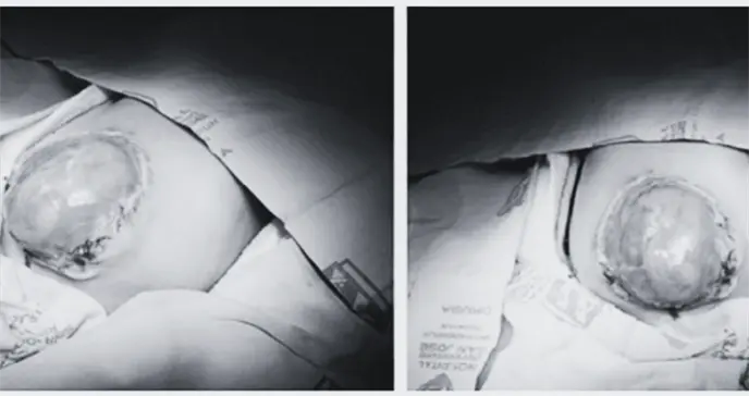 Neonato presenta gastrosquisis grave con evisceración intestinal y malformaciones asociadas Neonato presenta gastrosquisis grave con evisceración intestinal y malformaciones asociadas