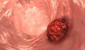 Toxina bacteriana podría ser responsable del aumento de cáncer colorrectal en personas menores de 50 años