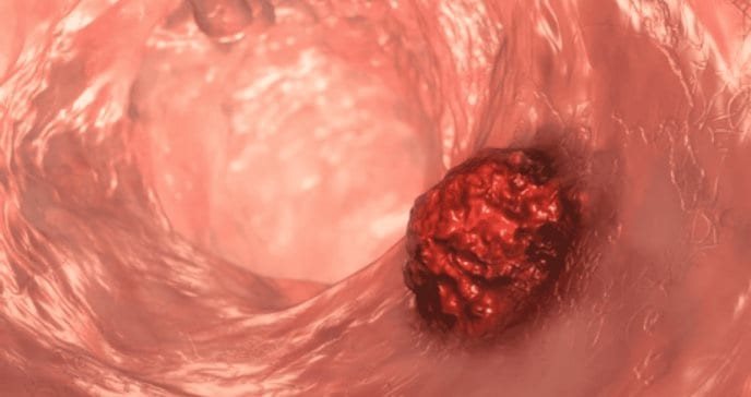 Toxina bacteriana podría ser responsable del aumento de cáncer colorrectal en personas menores de 50 años