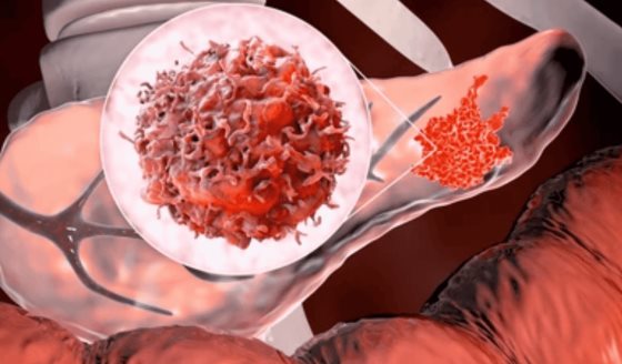 Nueva terapia combinada muestra eficacia contra cáncer de páncreas resistente al tratamiento
