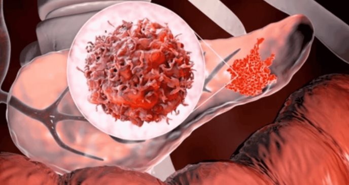 Nueva terapia combinada muestra eficacia contra cáncer de páncreas resistente al tratamiento