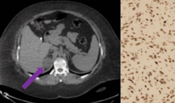 Tumor fibroso suprarrenal tratado con adrenalectomía laparoscópica asistida por robot