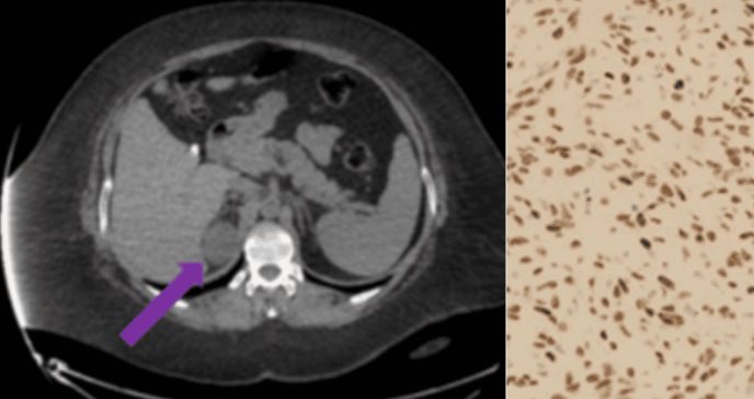 Tumor fibroso suprarrenal tratado con adrenalectomía laparoscópica asistida por robot