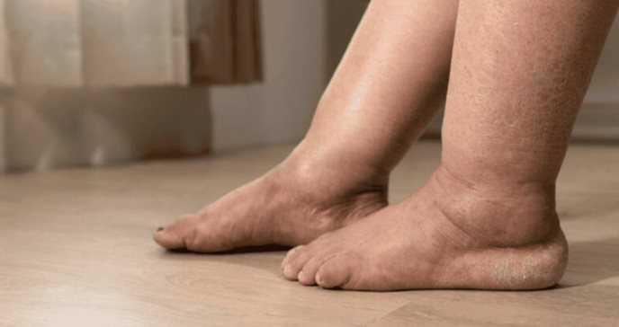 Hinchazón en las piernas, aumento de peso y retención de líquidos: Signos del edema que debe reconocer