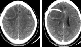 Recaída de neurocisticercosis activa por posible reinfección asociada a malas condiciones sanitarias