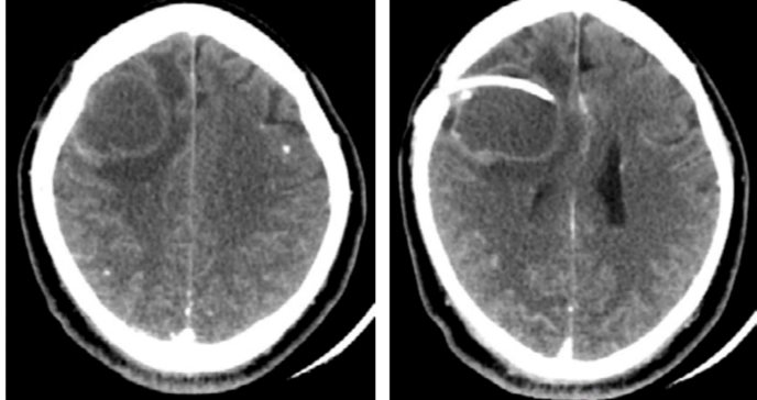Recaída de neurocisticercosis activa por posible reinfección asociada a malas condiciones sanitarias