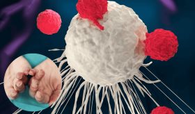 Terapia CAR-T salva por primera vez en el mundo a niña de 11 años con dermatomiositis anti-MDA5