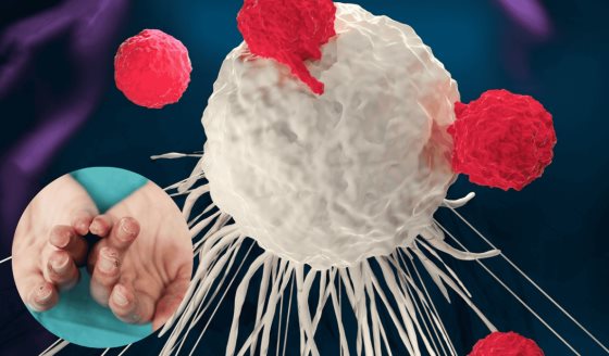 Terapia CAR-T salva por primera vez en el mundo a niña de 11 años con dermatomiositis anti-MDA5
