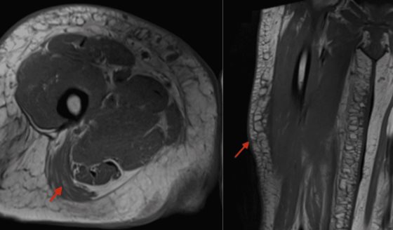 Mionecrosis del muslo derecho y nefropatía en mujer de 51 años como consecuencia de diabetes mal manejada