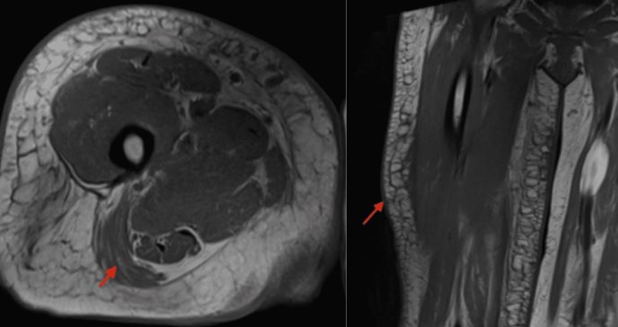 Mionecrosis del muslo derecho y nefropatía en mujer de 51 años como consecuencia de diabetes mal manejada