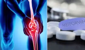 Medicamento Metformina para la diabetes demostró eficacia para la osteoartritis y el dolor de rodilla