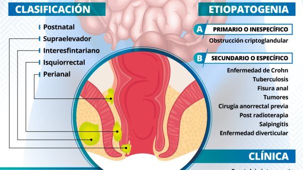 ABSCESOS PERIANALES