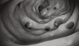 Descubren cómo la degradación de la proteína p53 desencadena el cáncer de colon en etapas tempranas 