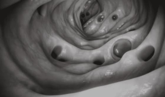 Descubren cómo la degradación de la proteína p53 desencadena el cáncer de colon en etapas tempranas 