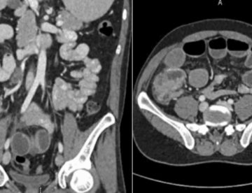 Paciente con carcinoma medular de colon presenta invasión linfovascular, necrosis y afectación ganglionar