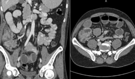 Paciente con carcinoma medular de colon presenta invasión linfovascular, necrosis y afectación ganglionar
