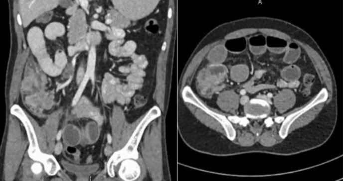 Paciente con carcinoma medular de colon presenta invasión linfovascular, necrosis y afectación ganglionar