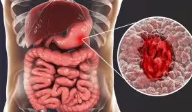 Eficacia del tacrolimús tópico en colitis ulcerosa distal alcanza remisión en un 47% de pacientes 
