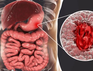 Eficacia del tacrolimús tópico en colitis ulcerosa distal alcanza remisión en un 47% de pacientes 