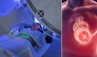 Técnica de radioterapia protege el corazón y mejora la supervivencia en pacientes con cáncer de pulmón