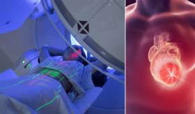 Técnica de radioterapia protege el corazón y mejora la supervivencia en pacientes con cáncer de pulmón