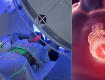 Técnica de radioterapia protege el corazón y mejora la supervivencia en pacientes con cáncer de pulmón
