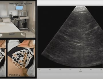 Así funciona el sostén con ultrasonido para detectar cáncer de mama en segundos