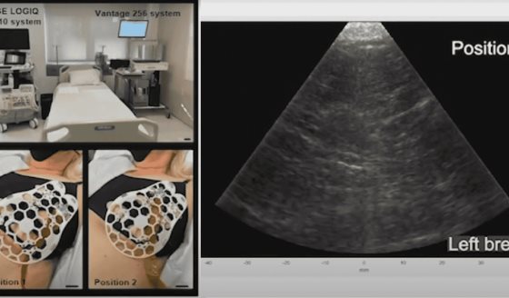 Así funciona el sostén con ultrasonido para detectar cáncer de mama en segundos