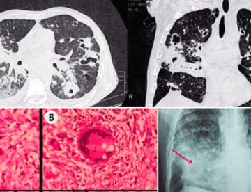 Necrosis tubular por shock séptico: Complicación fatal en paciente con coinfección fúngica en pulmones