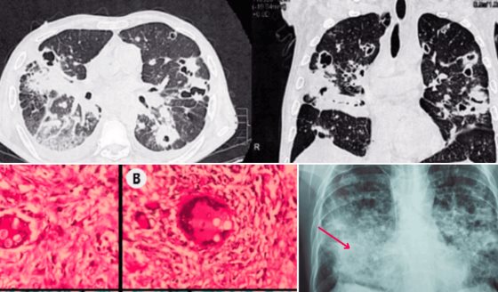 Necrosis tubular por shock séptico: Complicación fatal en paciente con coinfección fúngica en pulmones