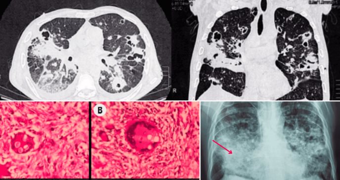 Necrosis tubular por shock séptico: Complicación fatal en paciente con coinfección fúngica en pulmones