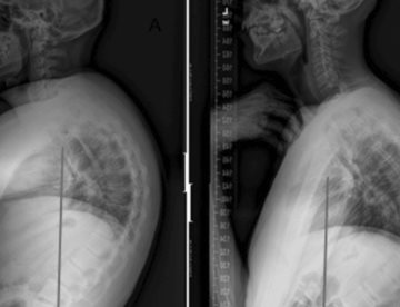 Envejecimiento vertebral: Hipercifosis puede causar pérdida de altura, dolor  y discapacidad funcional