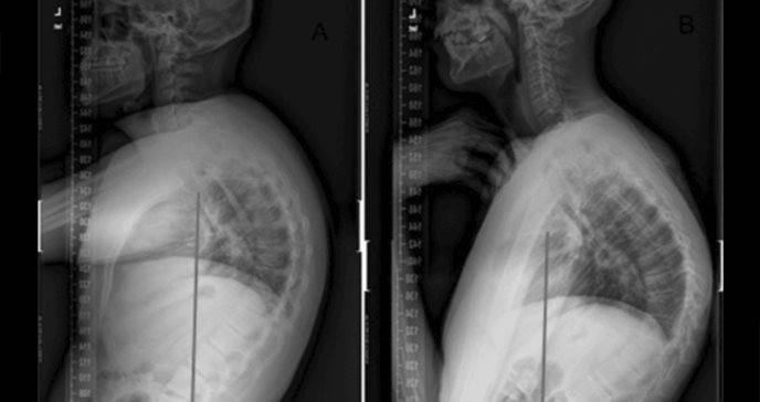 Envejecimiento vertebral: Hipercifosis puede causar pérdida de altura, dolor  y discapacidad funcional
