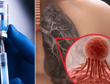 Investigadores desarrollan primera vacuna terapéutica contra el cáncer de pulmón