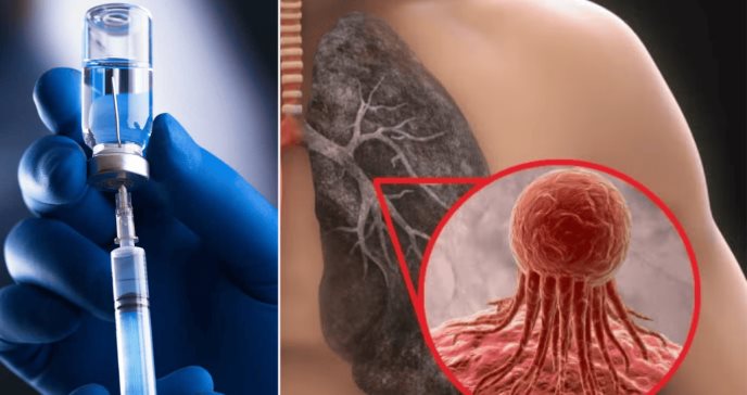 Investigadores desarrollan primera vacuna terapéutica contra el cáncer de pulmón