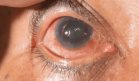Científicos descubren que el daño en el glaucoma estaría relacionado con un metabolismo retinal alterado