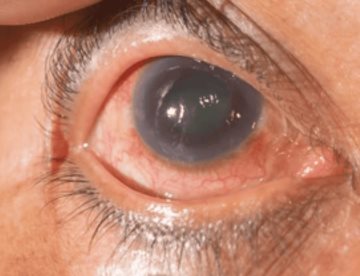 Científicos descubren que el daño en el glaucoma estaría relacionado con un metabolismo retinal alterado
