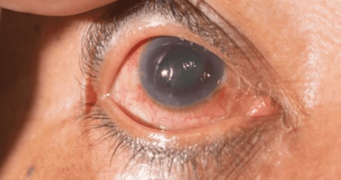 Científicos descubren que el daño en el glaucoma estaría relacionado con un metabolismo retinal alterado