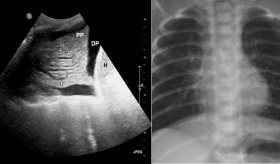 Ecografía pulmonar detecta insuficiencia cardíaca en pacientes con infarto de miocardio sin síntomas