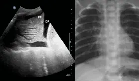 Ecografía pulmonar detecta insuficiencia cardíaca en pacientes con infarto de miocardio sin síntomas