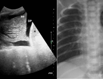 Ecografía pulmonar detecta insuficiencia cardíaca en pacientes con infarto de miocardio sin síntomas