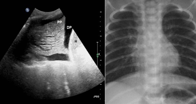 Ecografía pulmonar detecta insuficiencia cardíaca en pacientes con infarto de miocardio sin síntomas