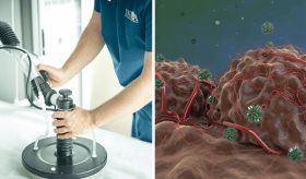 Oncothermia: Terapia no invasiva que usa radiofrecuencia para destruir tumores sin afectar tejidos sanos