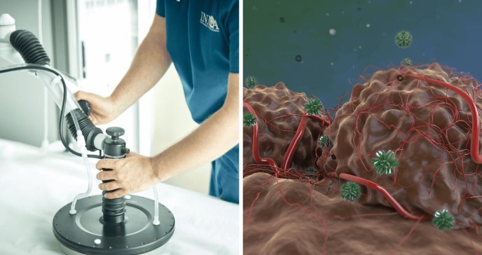 Oncothermia: Terapia no invasiva que usa radiofrecuencia para destruir tumores sin afectar tejidos sanos