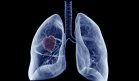 Preocupación ante el aumento los casos de cáncer de pulmón en personas no fumadoras